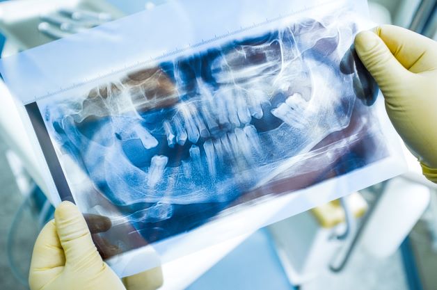 Treatment of Periodontitis in Smoking Patients with the Lumoral Method